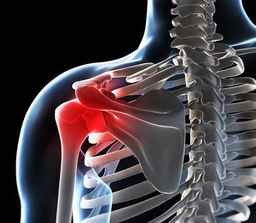 Síndrome de Fricción Subacromial y Lesiones del Manguito Rotador