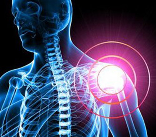 Tendinitis Calcificante