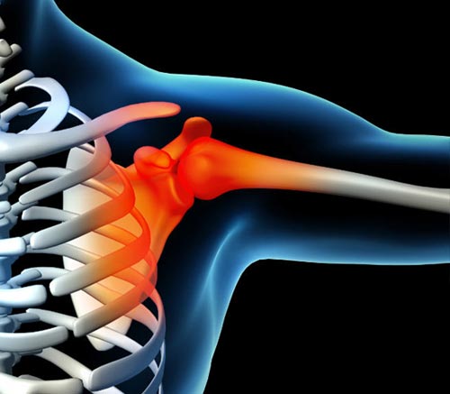Luxaciones Acromioclaviculares